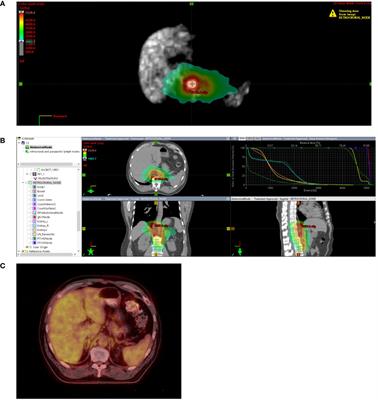 Long-term disease-free survival following comprehensive involved site radiotherapy for oligometastases